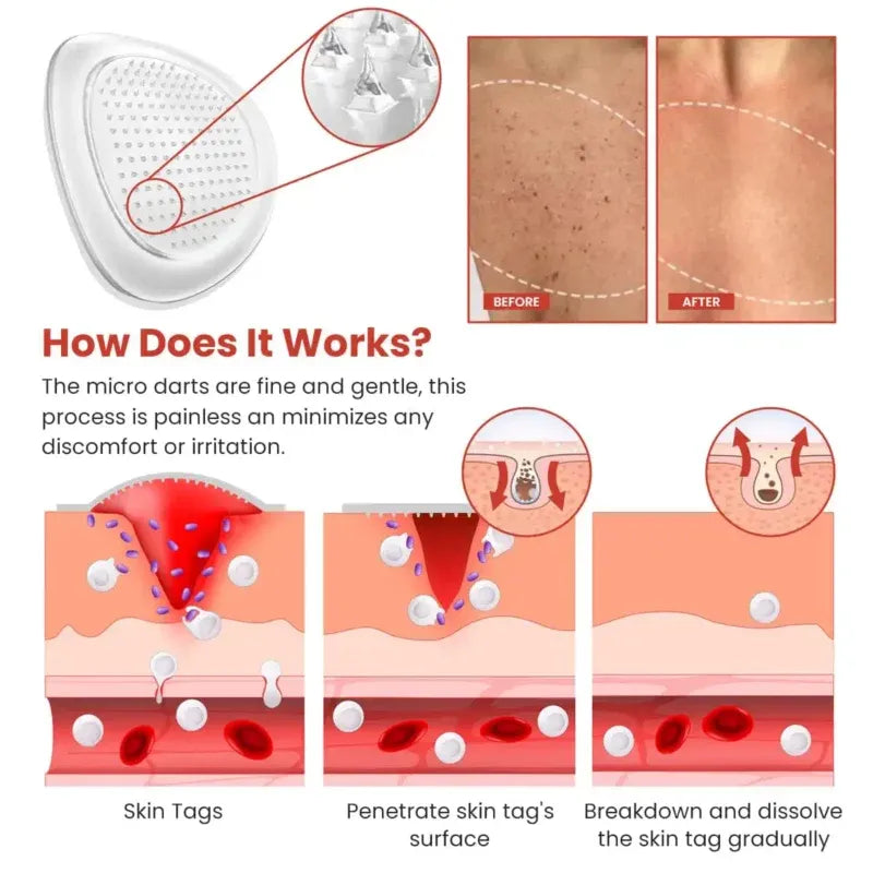 Derma Smooth Skin Tag Removal Patch | Secret to Spotless Skin